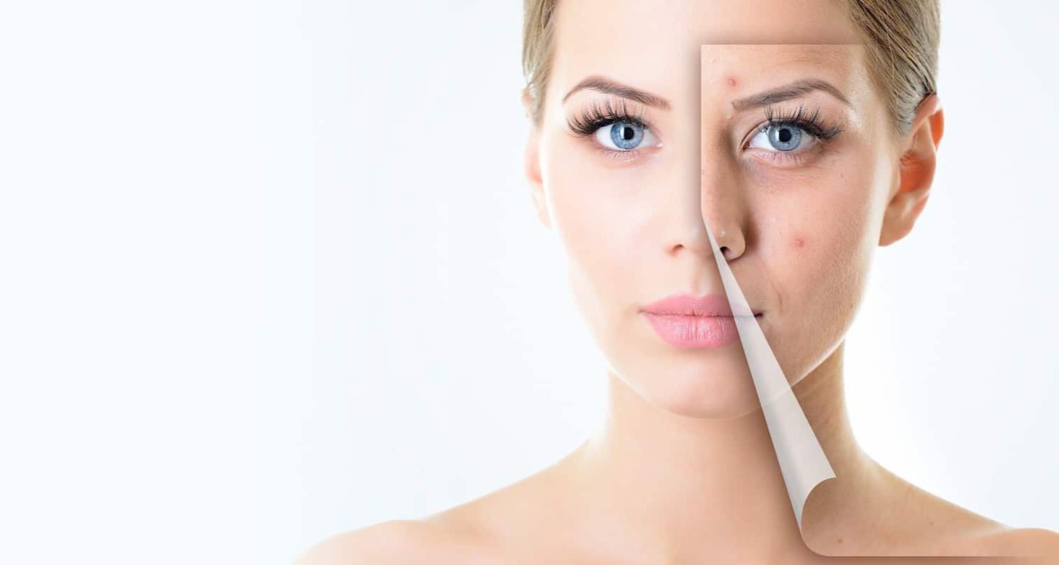 Effective Treatments for Acne